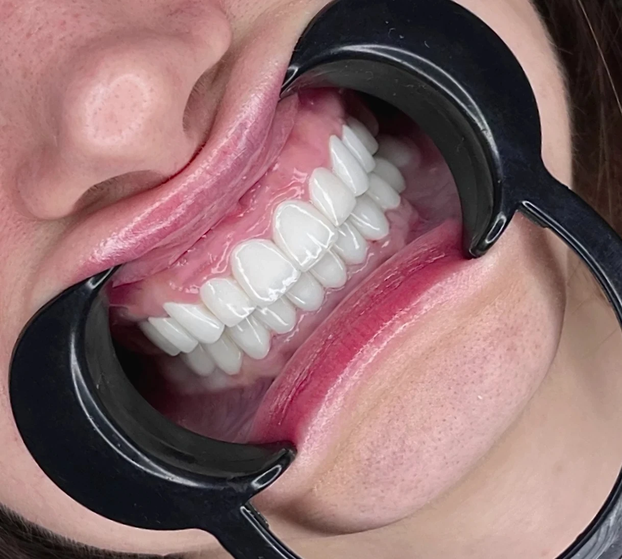 Şeffaf Plak ve Geleneksel Diş Teli Karşılaştırma Görseli